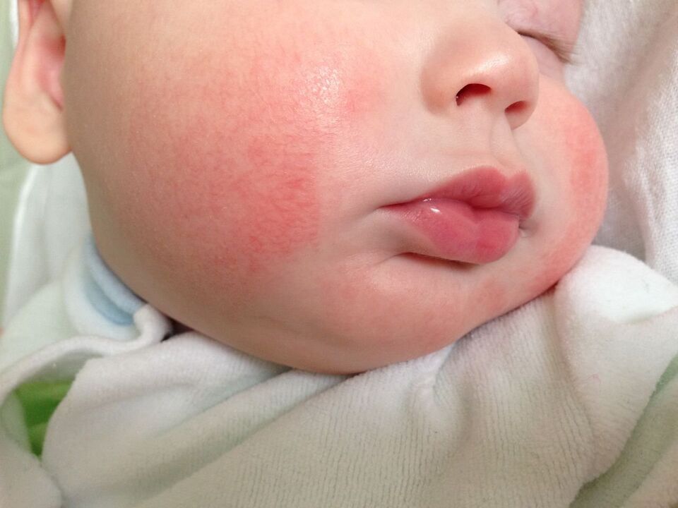 One sign of worms in a child is allergic urticaria